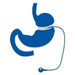 Adjustable Gastric Band